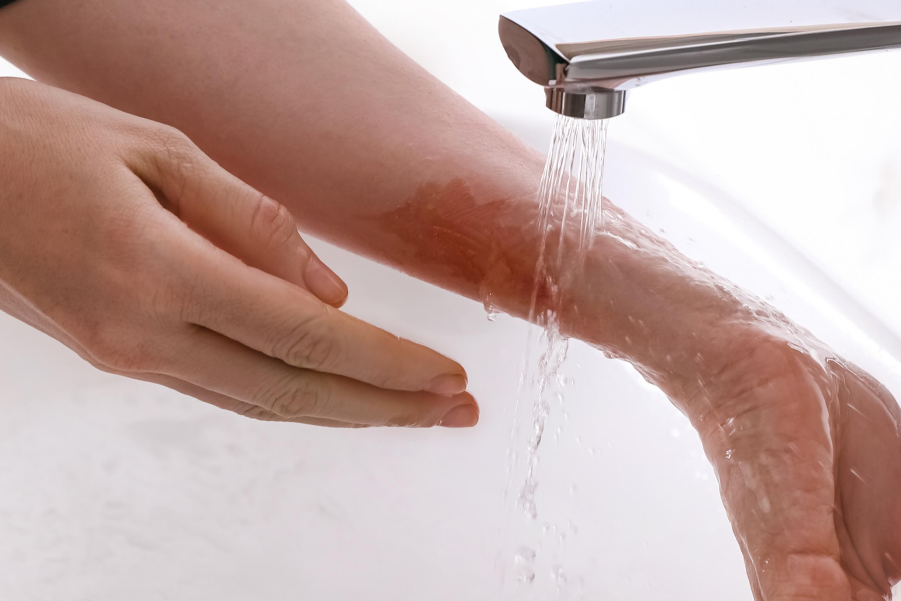 Piel quemada bajo agua fría